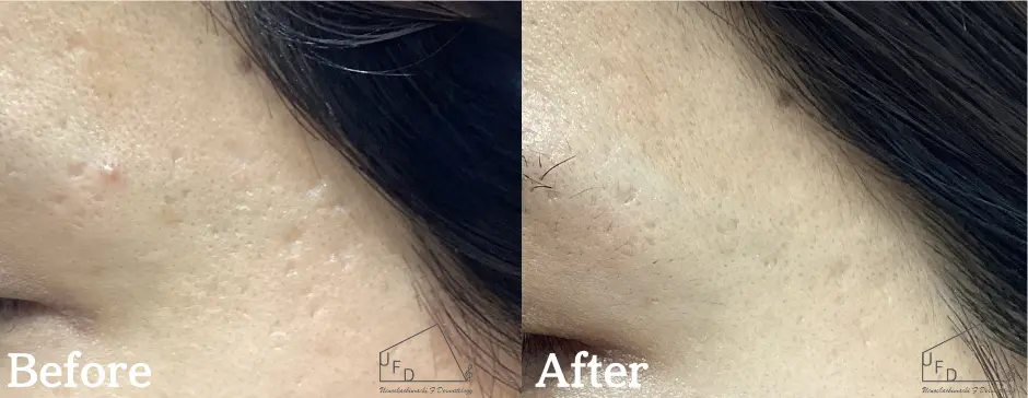 症例3 【20歳代女性】左こめかみのニキビ跡の写真