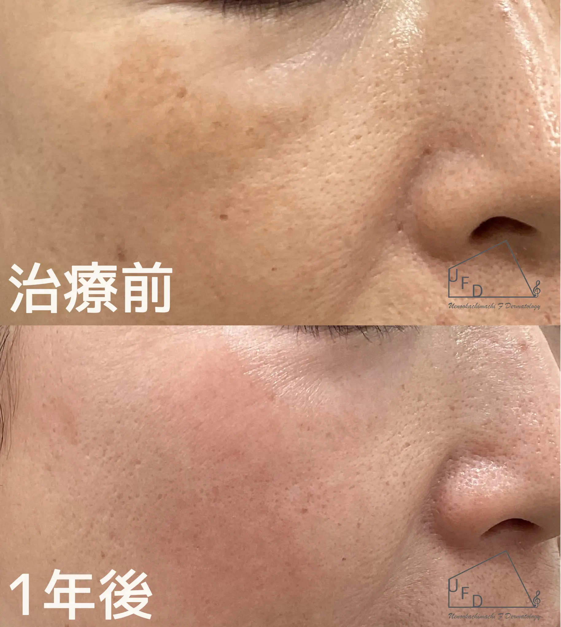症例 4【40歳代女性】両頬の肝斑画像