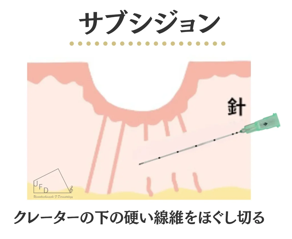 サブシジョンの施術方法