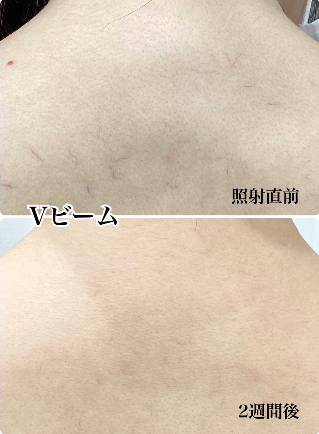 毛細血管拡張症 症例2