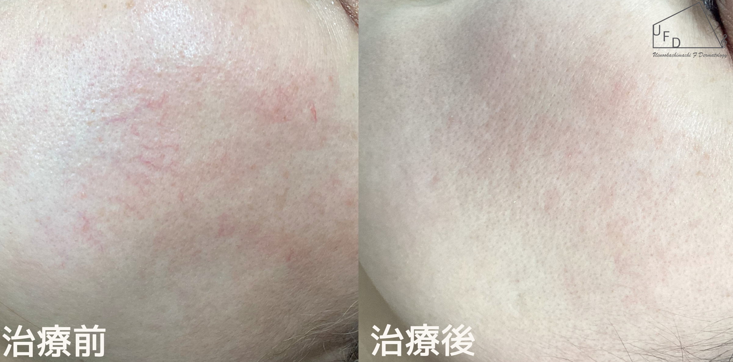 毛細血管拡張症 症例1