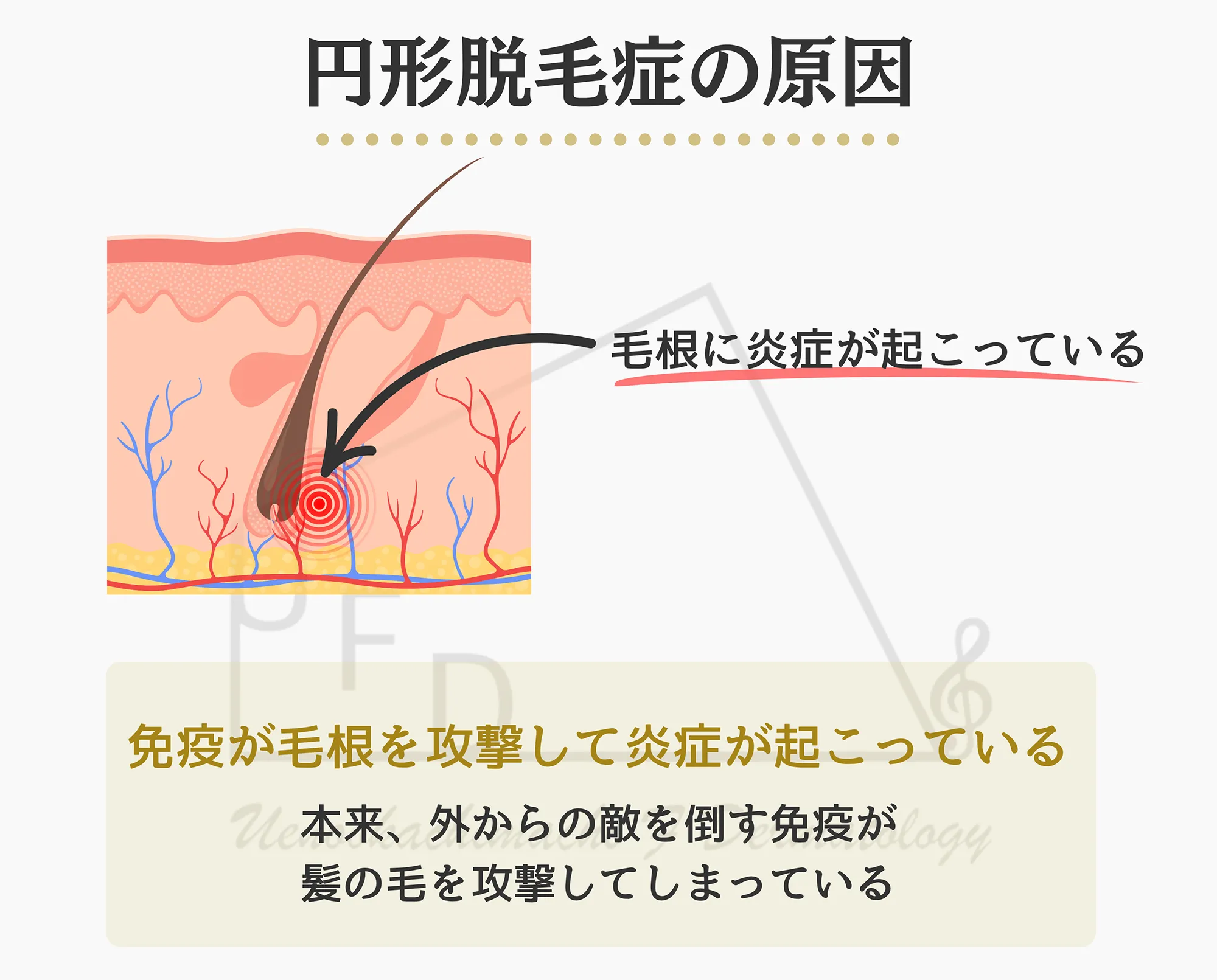 円形脱毛症の原因をイラストでわかりやすく説明