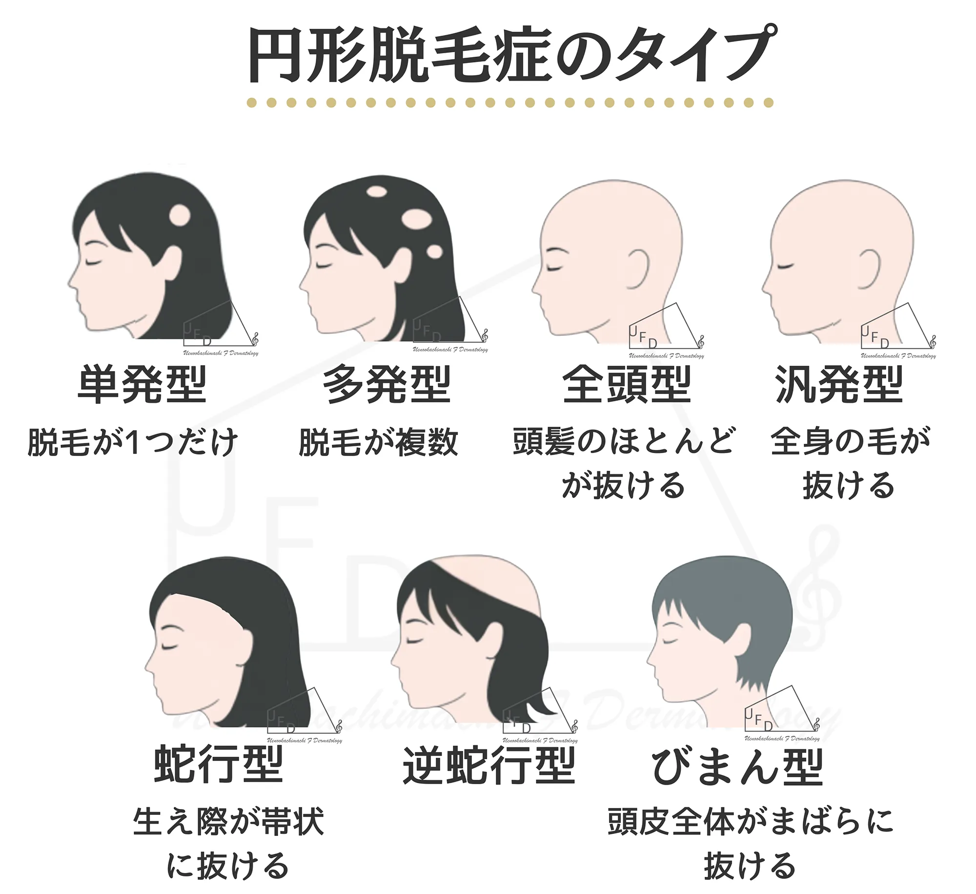 円形脱毛症の5つのタイプを画像とともに詳しく解説 進行度についても解説します