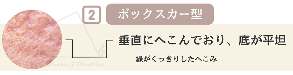 ニキビ跡の一種 ボックスカー型について特徴 原因 主訴を詳しく解説