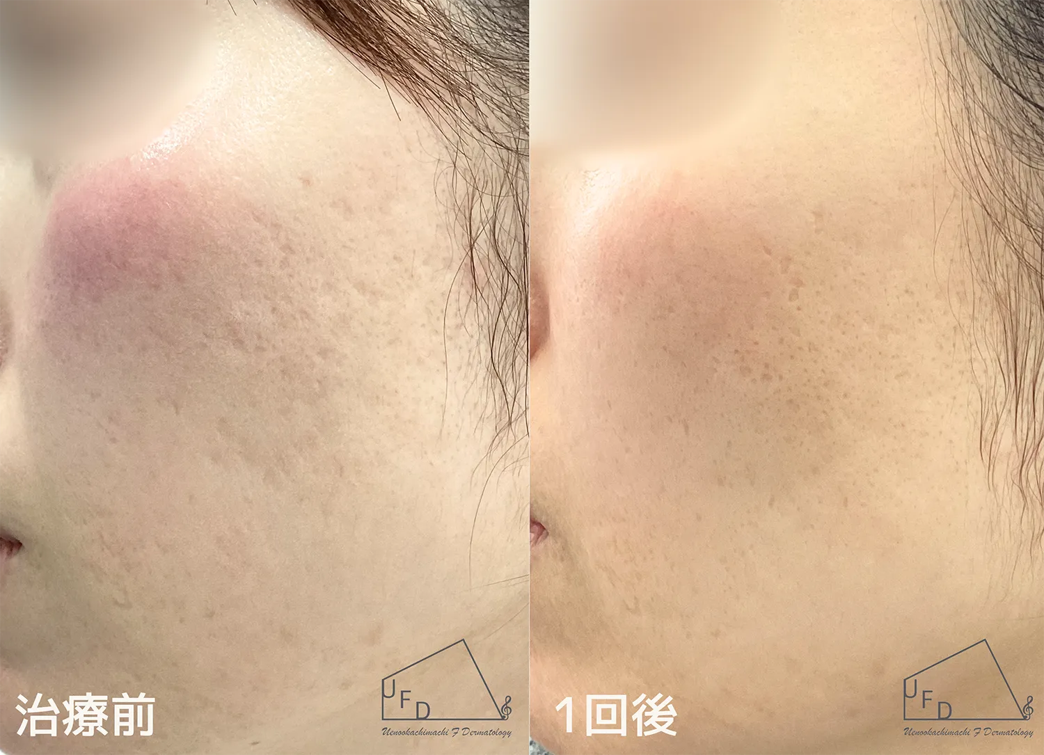 サブシジョンの施術症例について解説 症例2