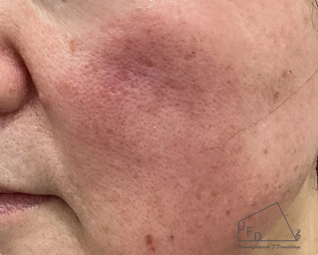 多くの方が悩まされる赤ら顔や顔のほてり 原因や症状 治療法について詳しく解説します