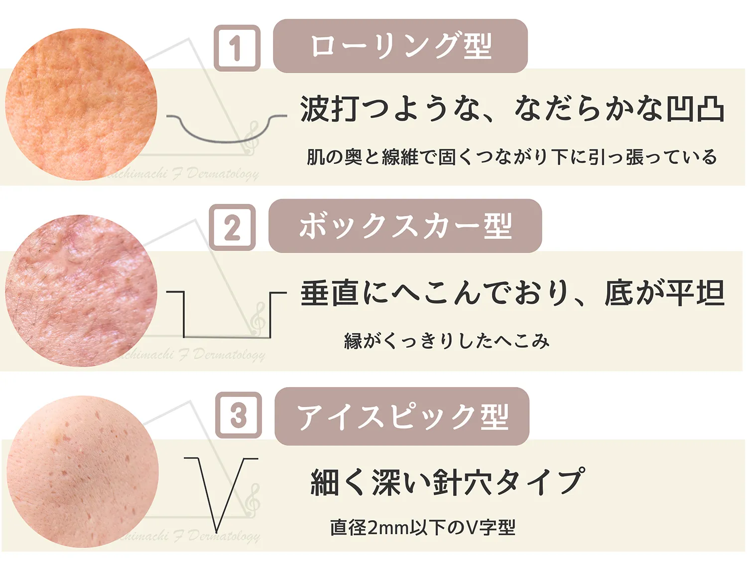 ニキビ跡の主な3タイプについて画像付きで解説