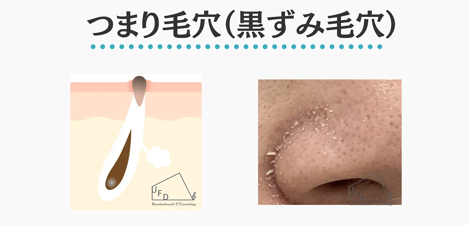 つまり毛穴 黒ずみ毛穴の特徴と治療法について解説