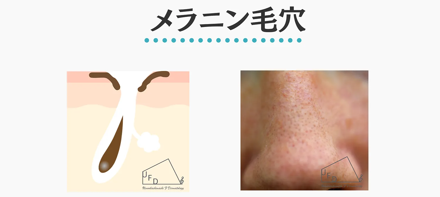 メラニン毛穴の特徴と治療法について解説