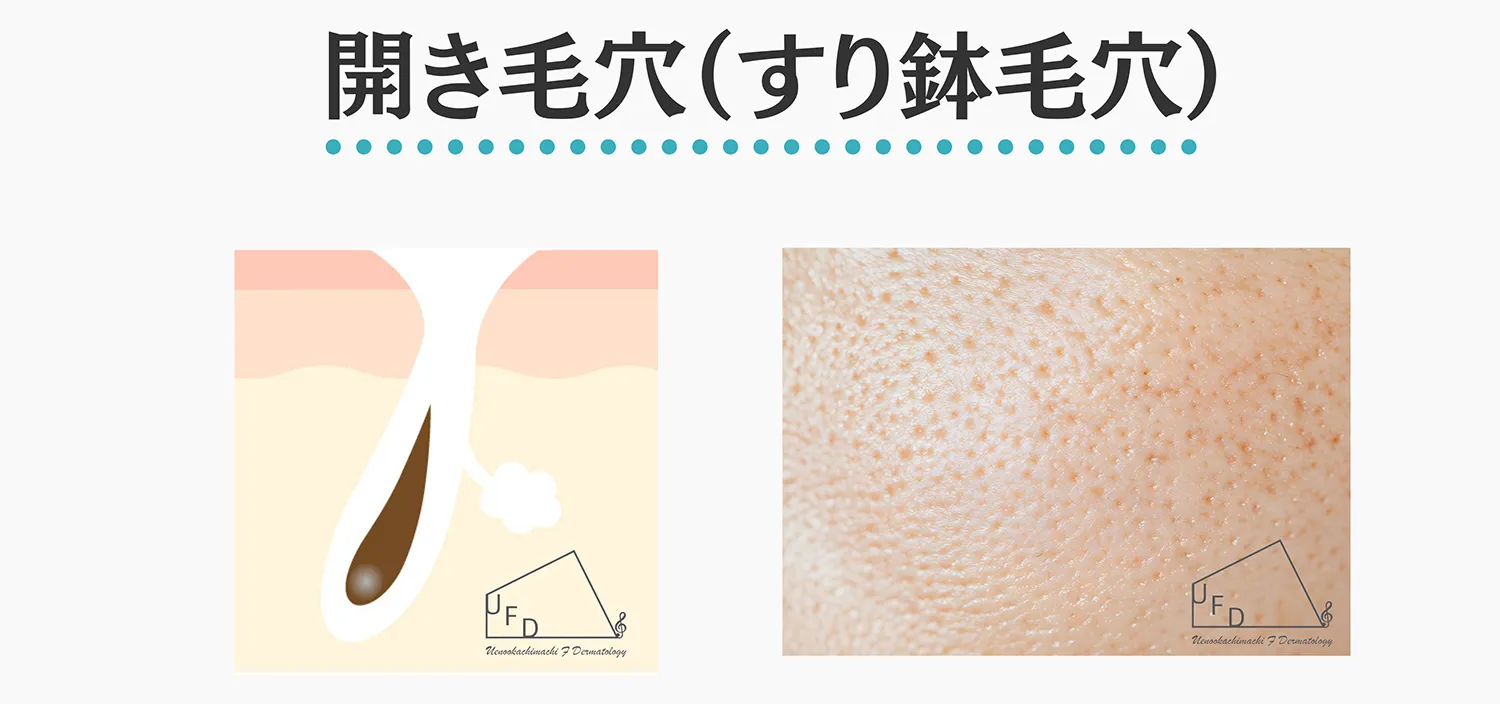 開き毛穴の特徴と治療法について解説