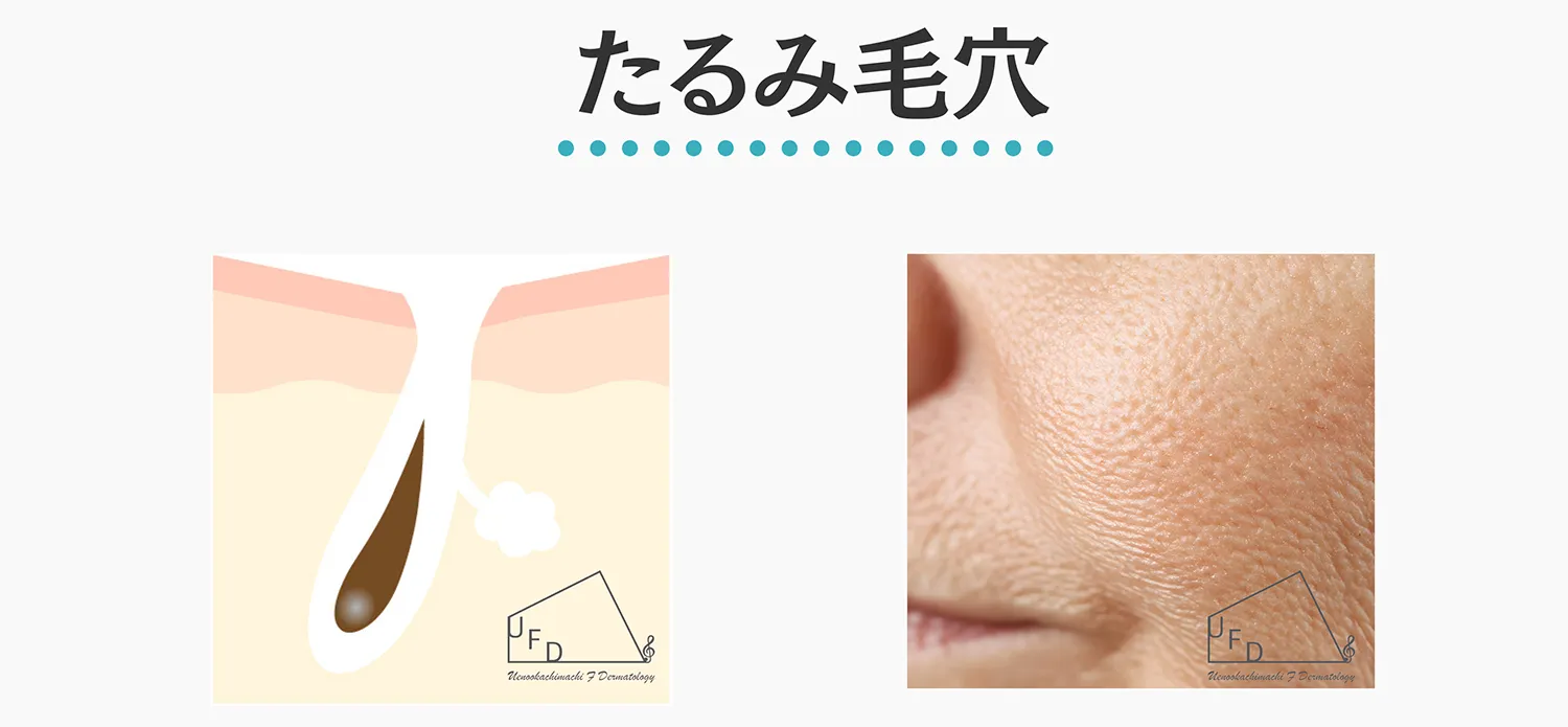 たるみ毛穴の特徴と治療法について解説