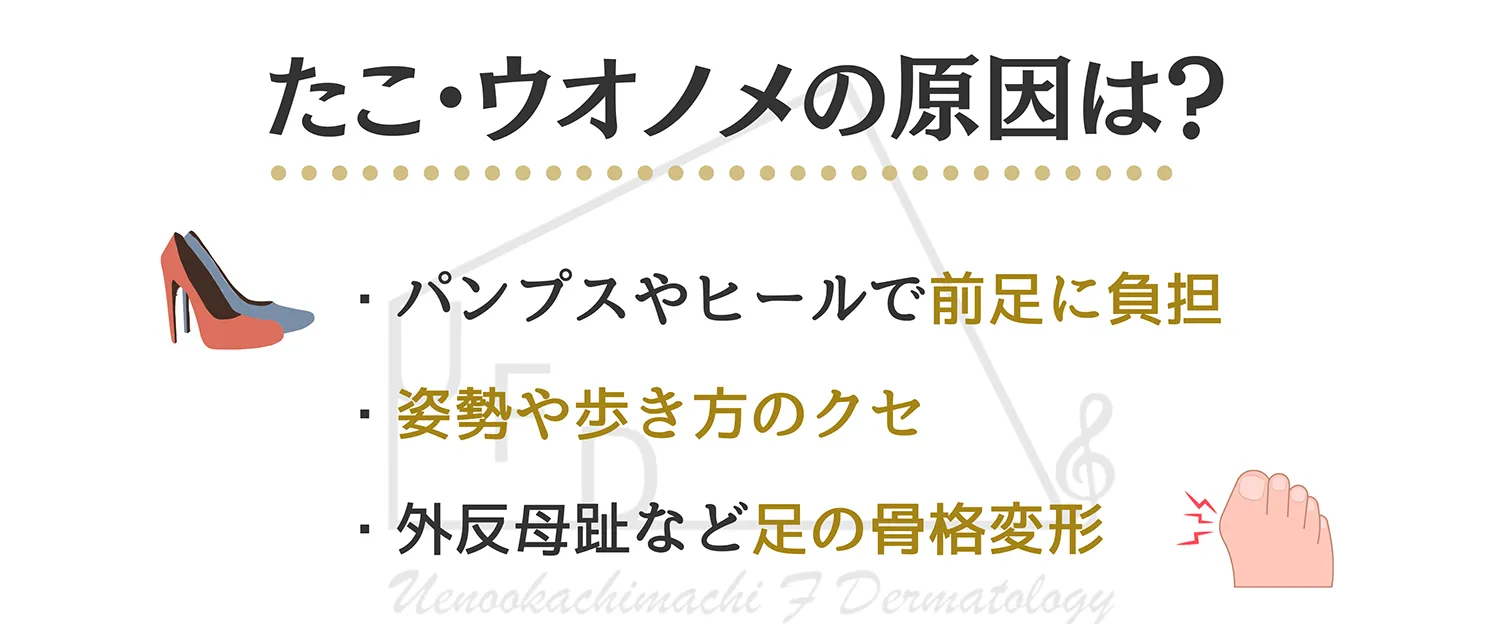 たこ うおのめの原因について詳しく解説