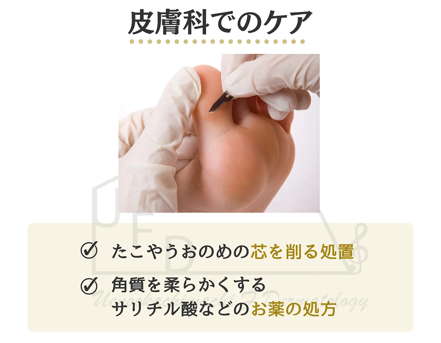 たこ うおのめ皮膚科でのケアについて 画像付きで詳しく解説します