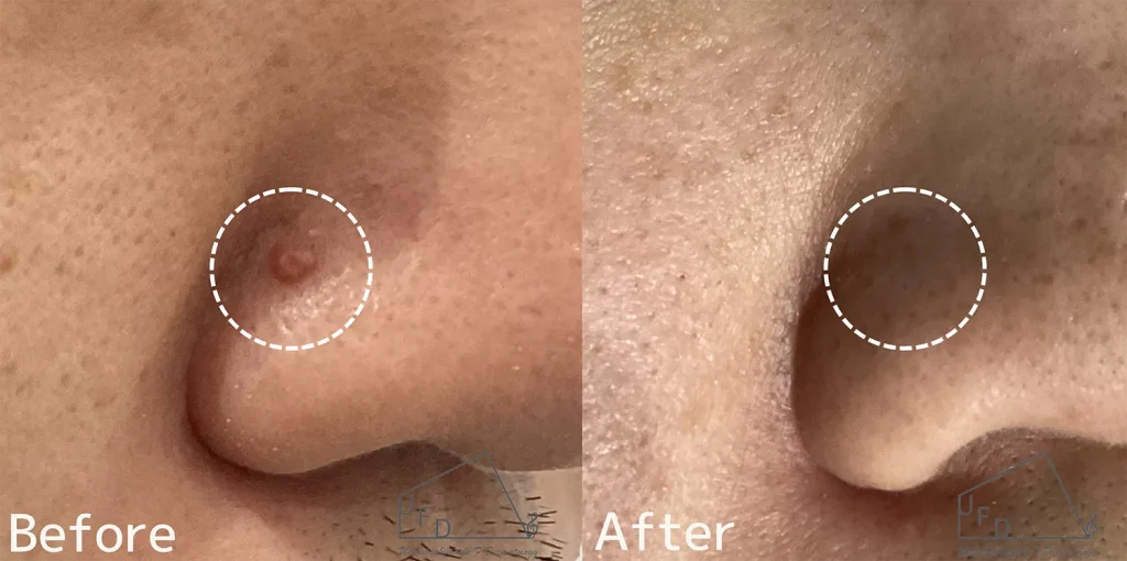 鼻のイボ治療症例画像2