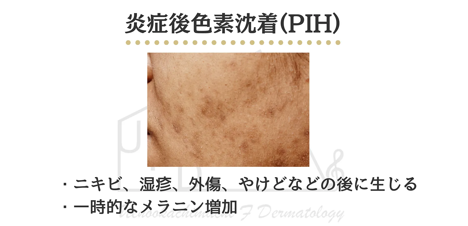 炎症後色素沈着 PIHの患部写真
