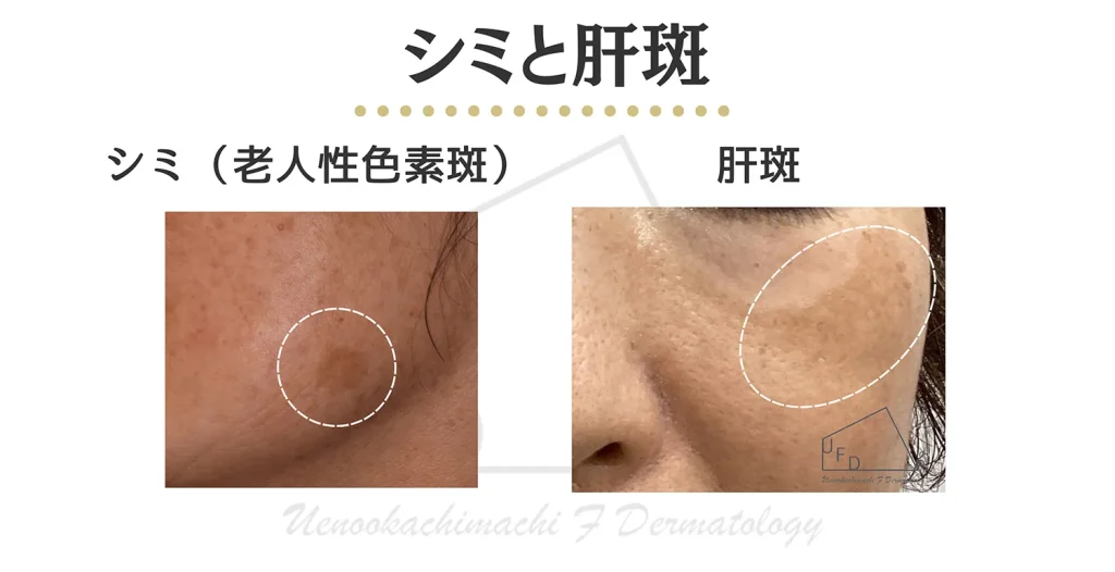 シミ(老人性色素斑)と肝斑