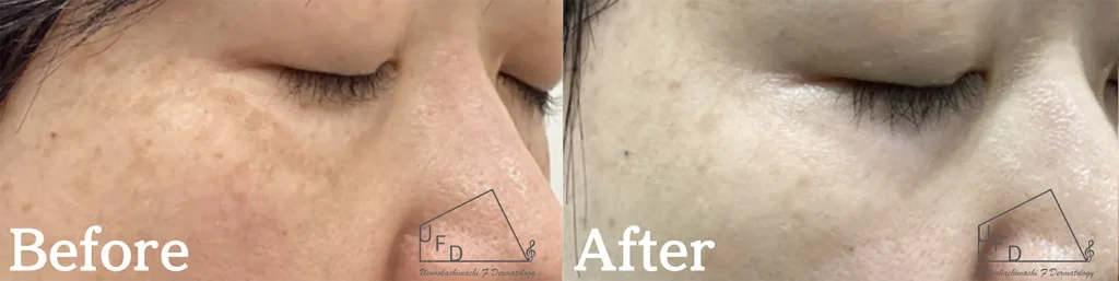 ハイドロキノン症例 【40歳代女性】両頬の肝斑、老人性色素斑