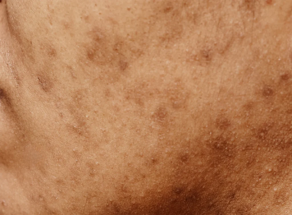 色素沈着患部の写真