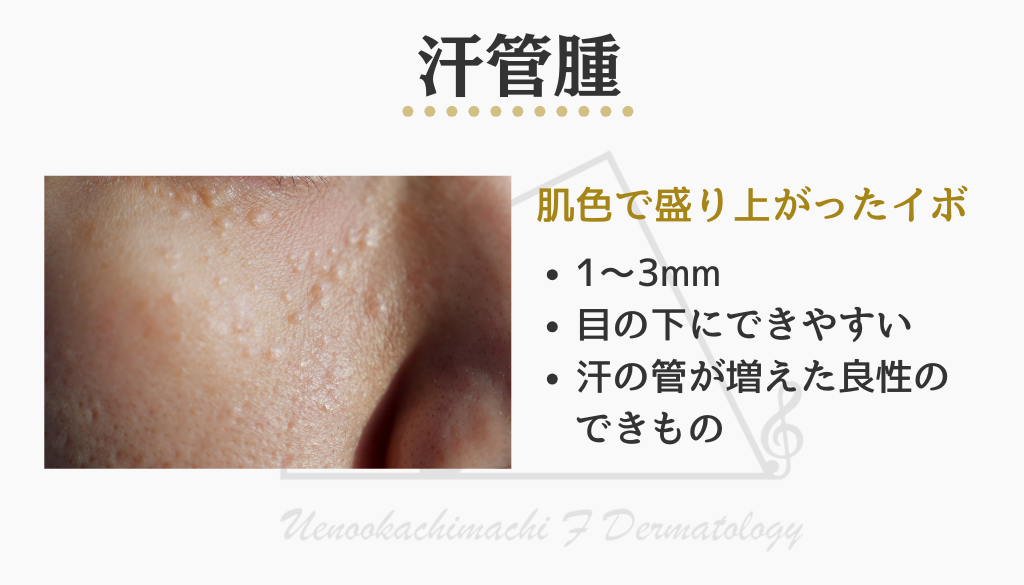 汗腺腫とは