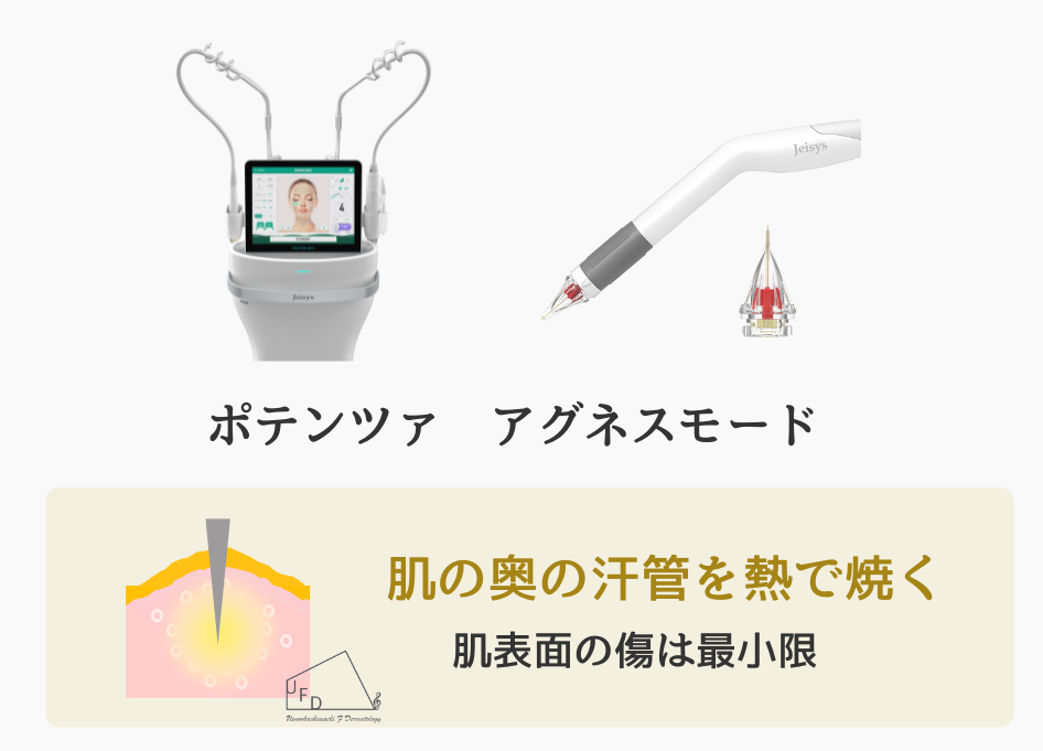 汗腺腫モード