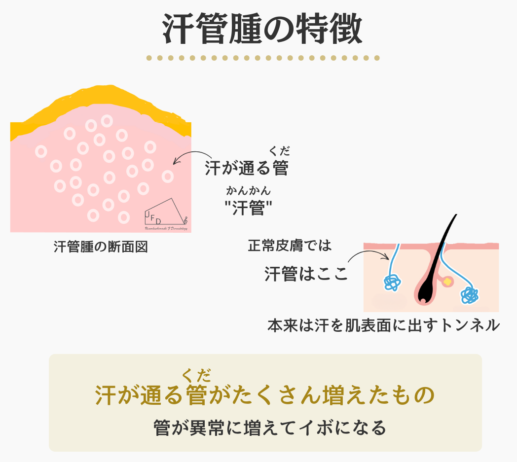 汗腺腫の特徴