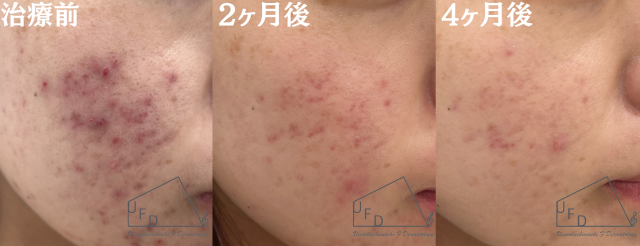 症例1【20歳代女性】頬のニキビ(イソトレチノイン 4ヶ月内服)