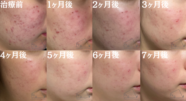 症例2【30歳代女性】頬のニキビ(イソトレチノイン 7ヶ月内服)