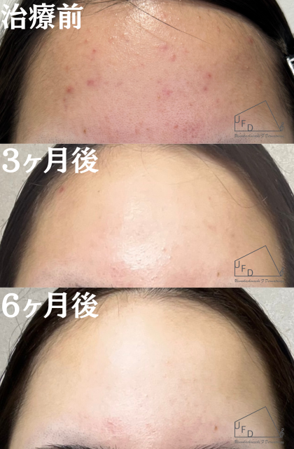 症例3【30歳代女性】額のニキビ(イソトレチノイン 6ヶ月内服)