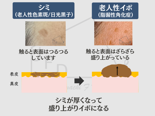老人性イボ(脂漏性角化症)