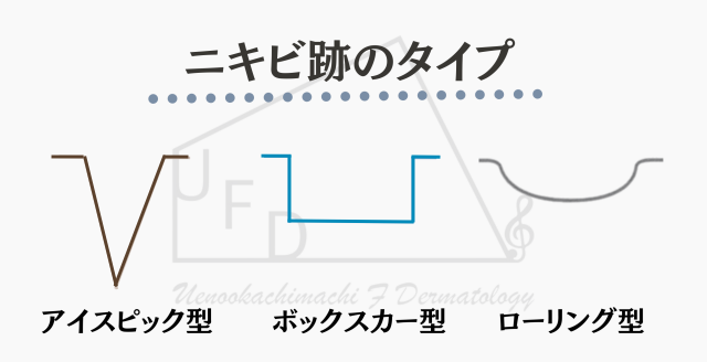 ニキビ跡のタイプ アイスピック型、ボックスカー型、ローリング型