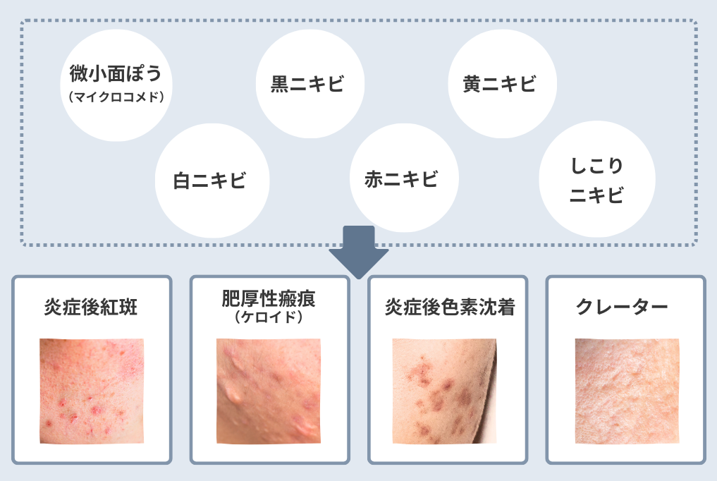 ニキビ跡