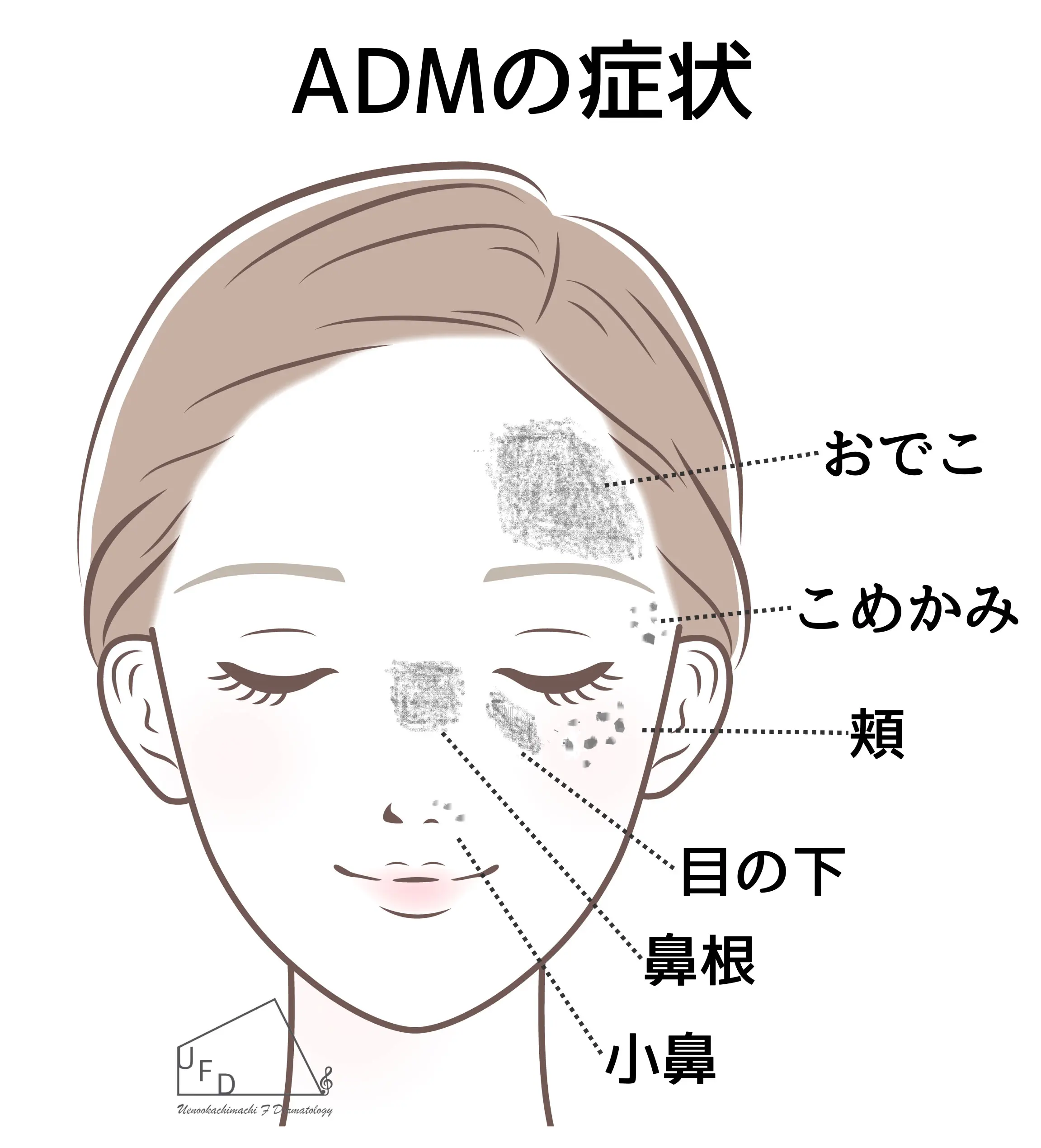 ADMの症状