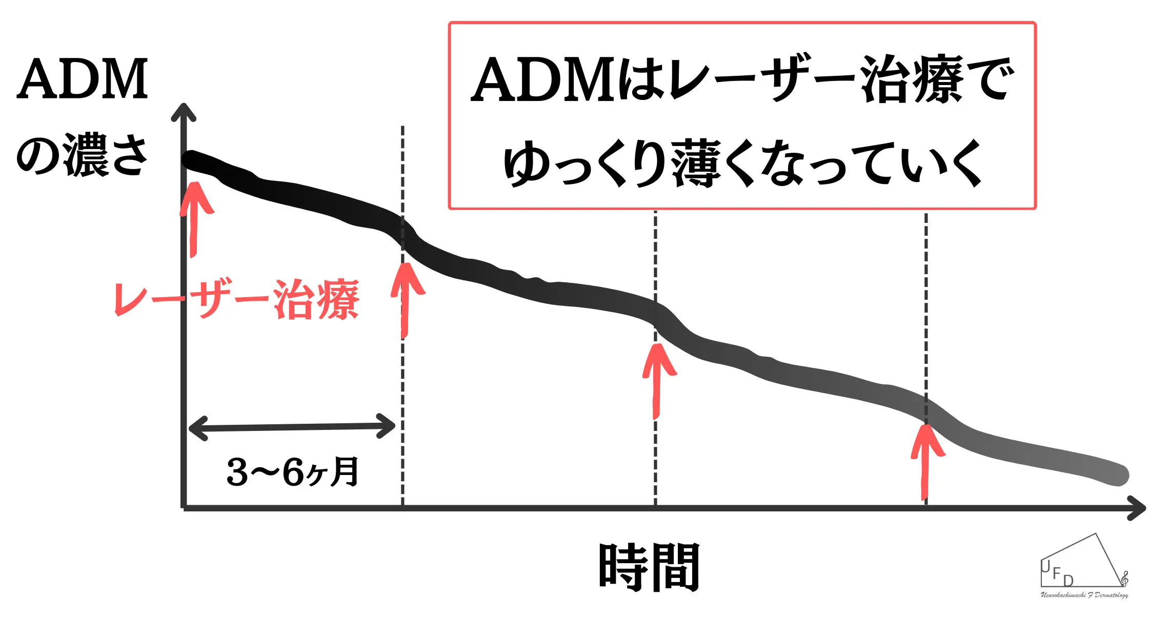 ADMの薄くなり方