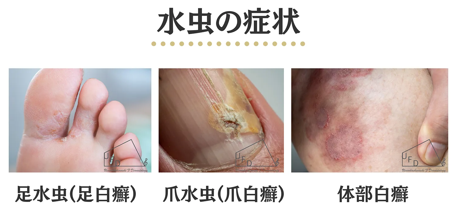 水虫の症状
