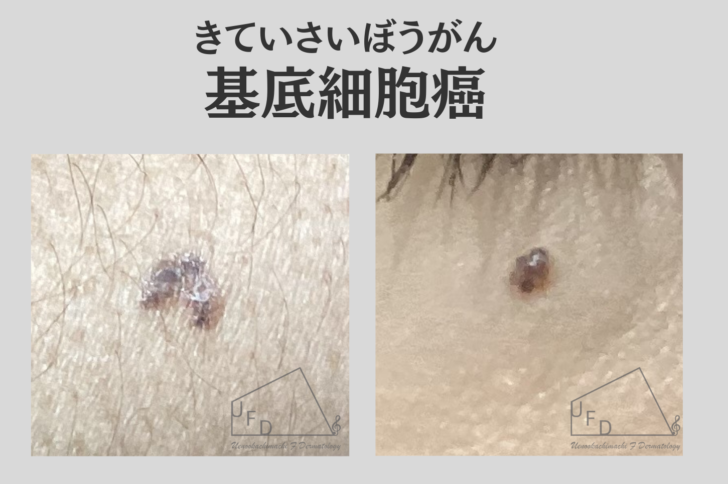 基底細胞癌(きていさいぼうがん、BCC:basal cell carcinoma)画像