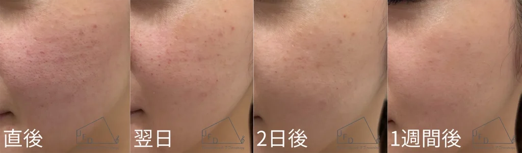 blessingのダウンタイム症例について紹介。症例2