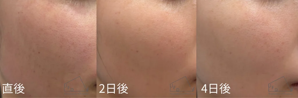 blessingのダウンタイム症例について紹介。症例1