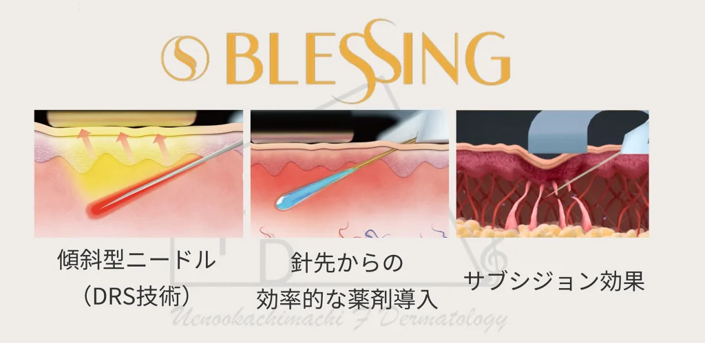 ブレッシングの仕組みについて写真付きで解説します 傾斜型ニードルを使用し 針先から効率的な薬剤を導入 サブシジョン効果も得られます