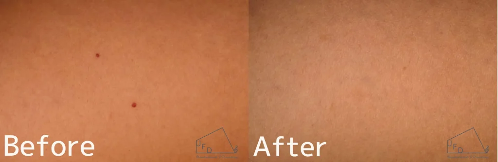 症例2 【30歳代男性】お腹のさくらんぼ血管腫