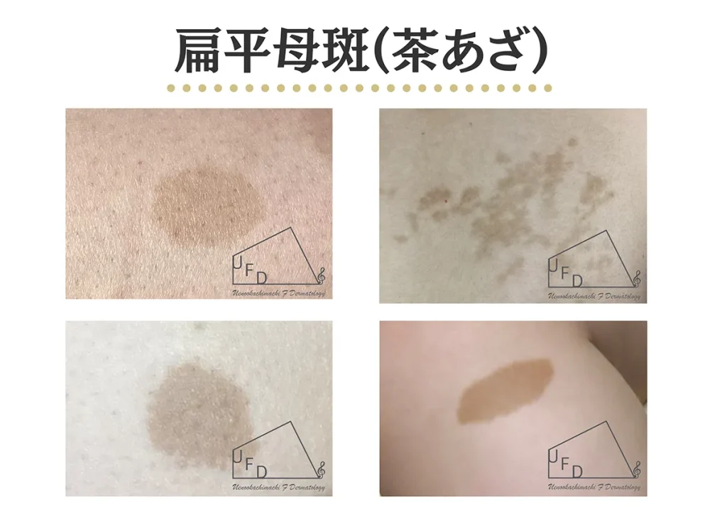 扁平母斑とは