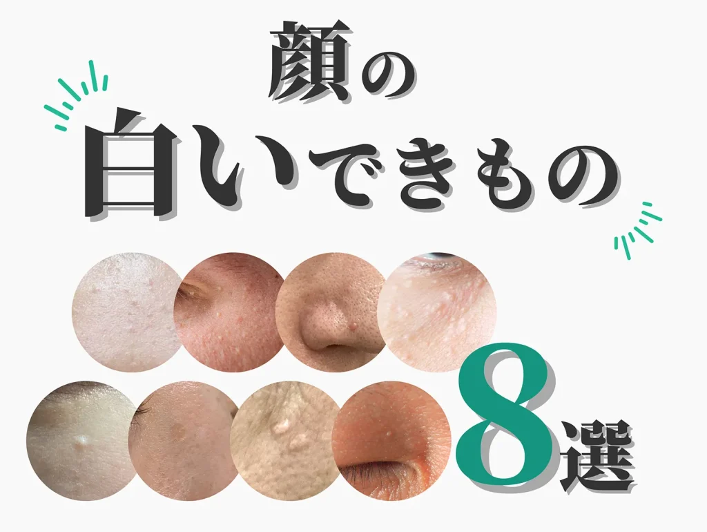 顔にできる気になる白いできもののついて画像付きで8種類解説 原因や治療法についても詳しく説明します