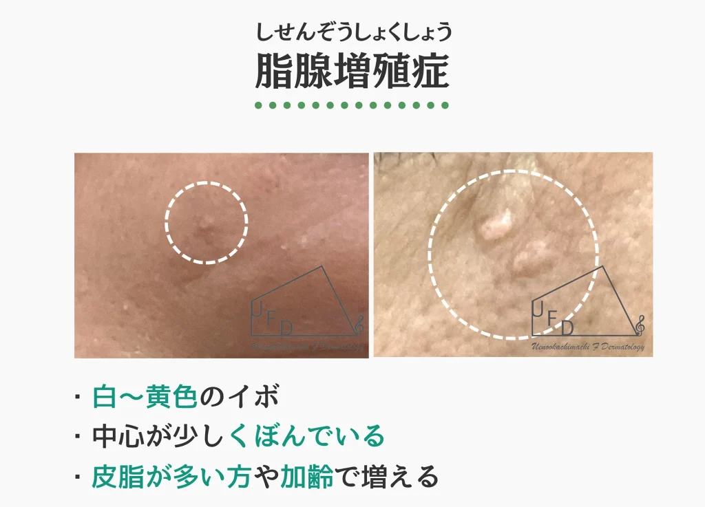 脂腺増殖症の症状写真 特徴や原因 治療法について解説
