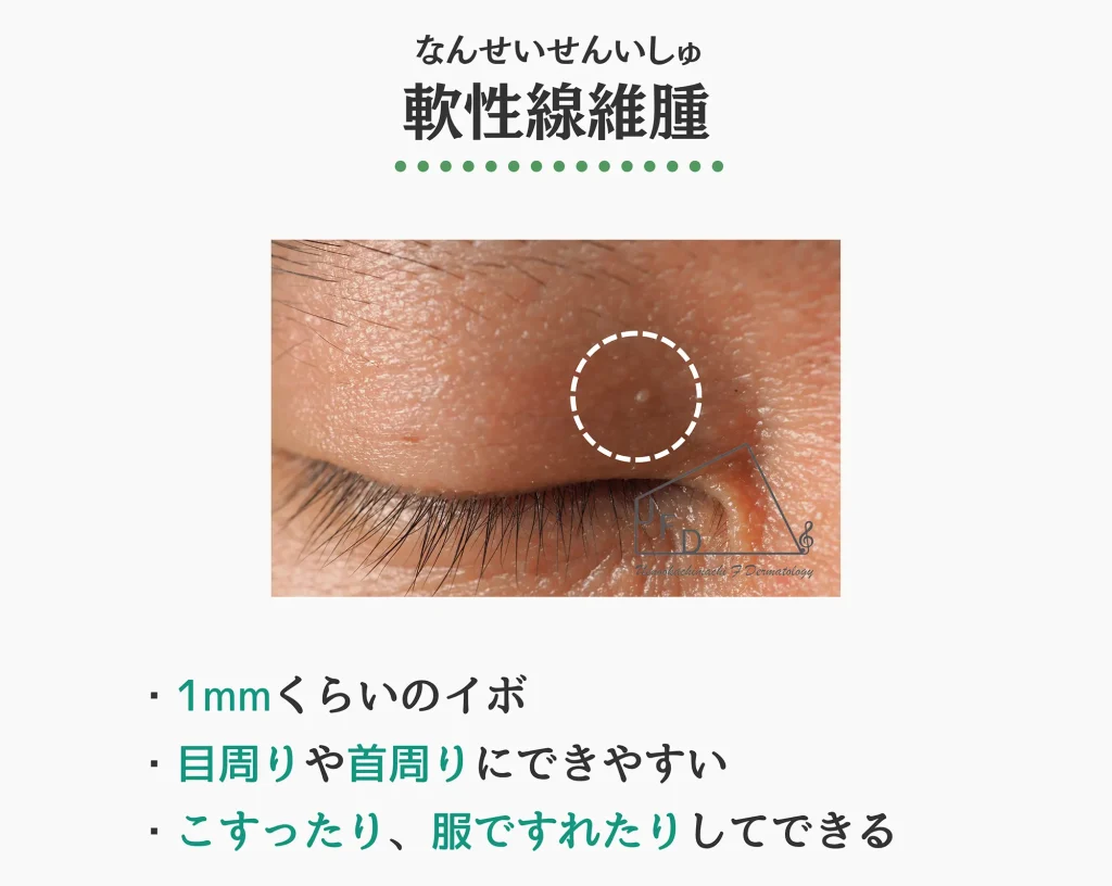 軟性線維腫の症状写真 特徴や原因 治療法について解説