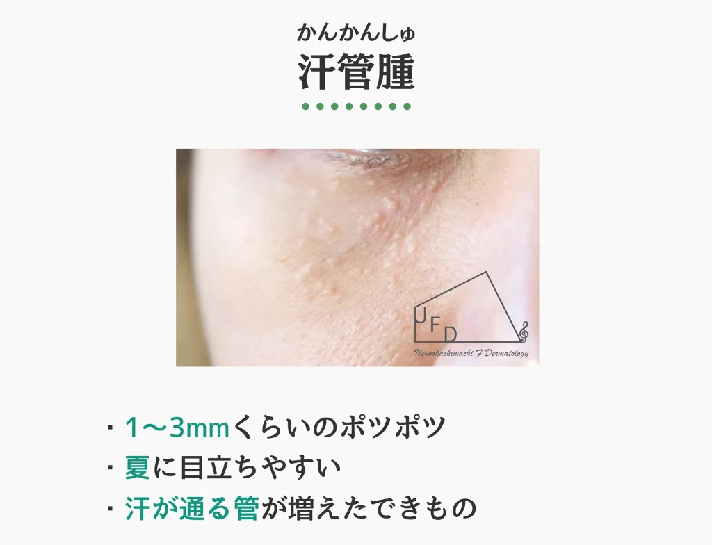 汗管腫の症状写真 特徴や原因 治療法について解説
