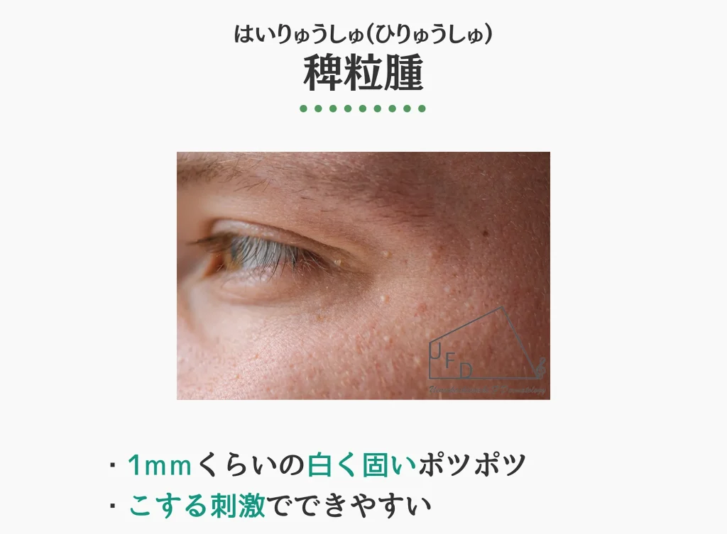 稗粒腫の症状写真 特徴や原因 治療法について解説