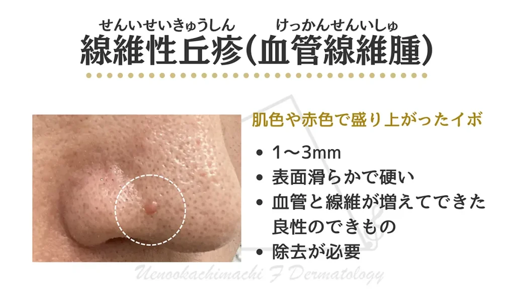 線維性丘疹の写真