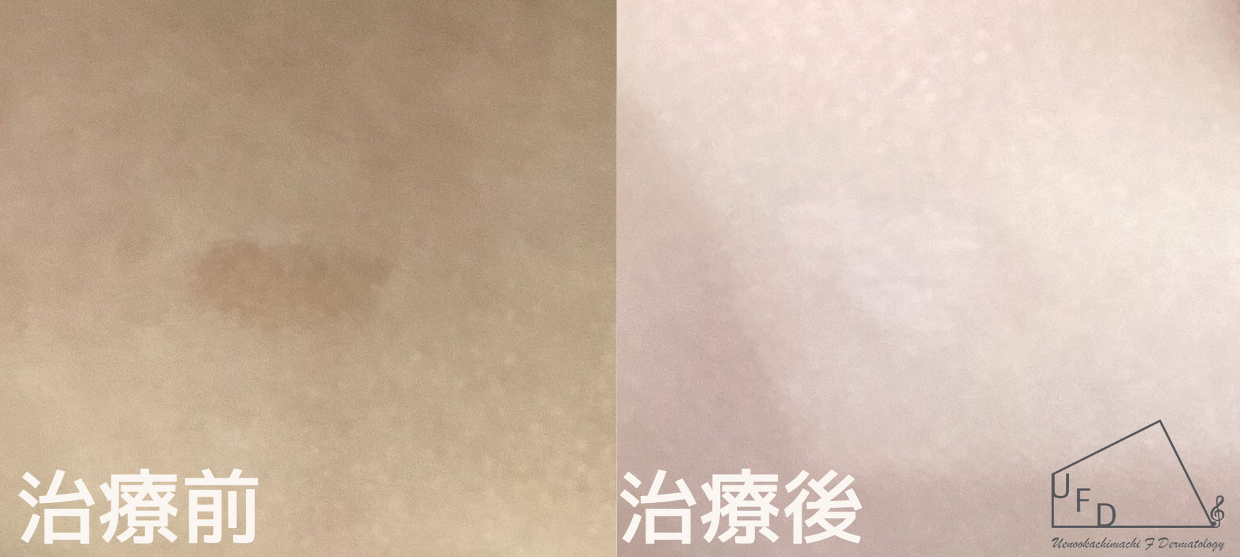 腹部の扁平母斑