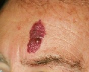単純性血管腫