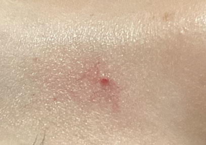 くも状血管腫