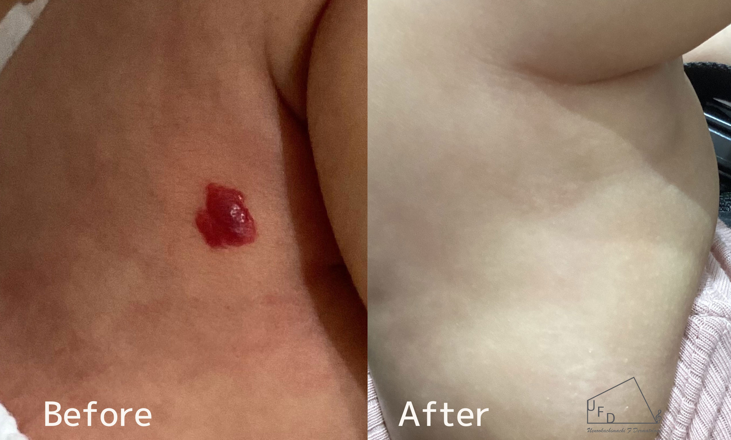 右大腿の乳児血管腫